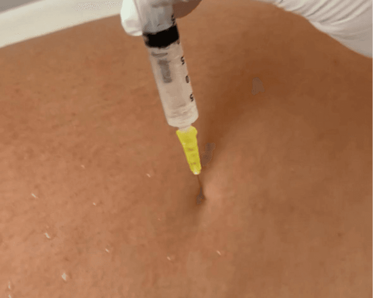 Pack de 4 sesiones - Mesoterapia Corporal