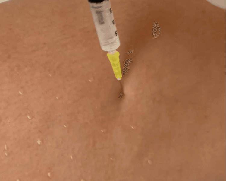 Mesoterapia Corporal