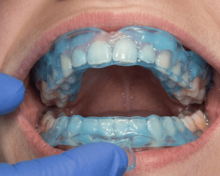 Fluoruro niño adolescente y/o adulto