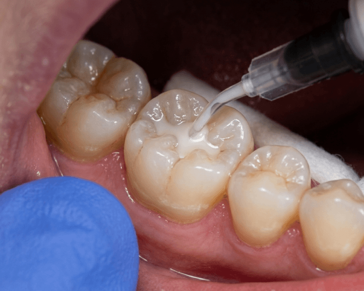 Selladores de fosetas y fisuras