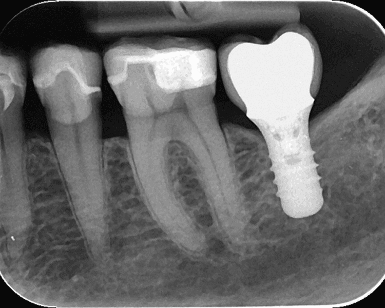 Radiografía periapical