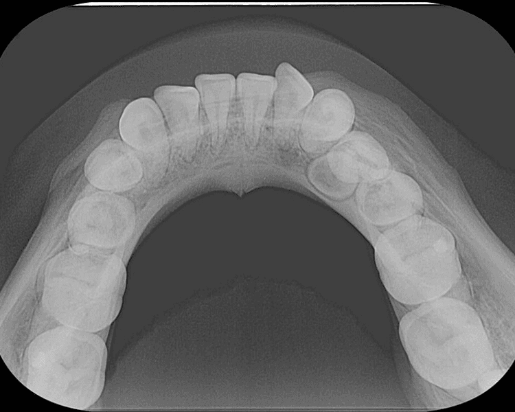 Radiografía oclusal