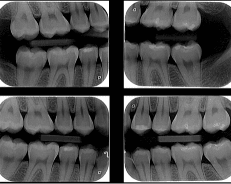 Radiografía aleta de mordida