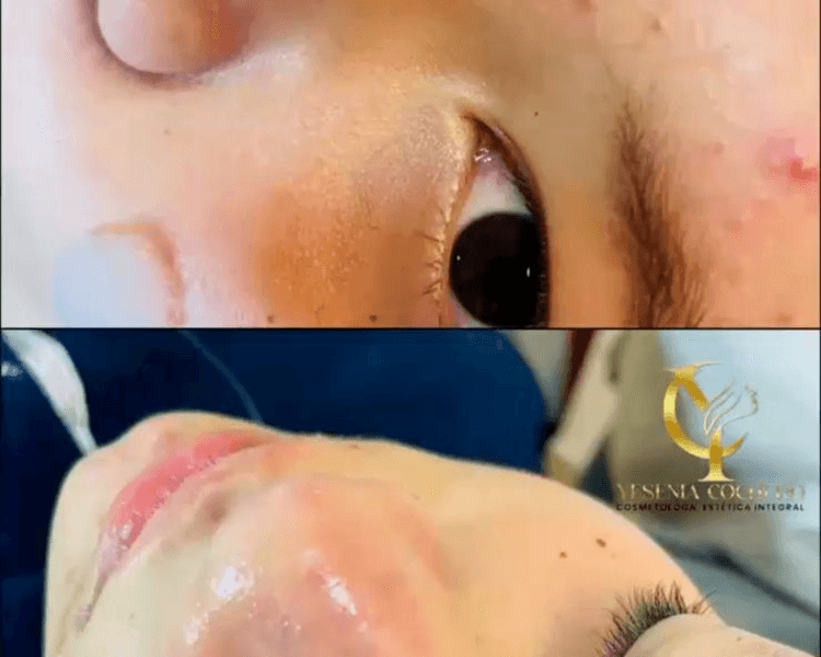 Limpieza Facial Profunda