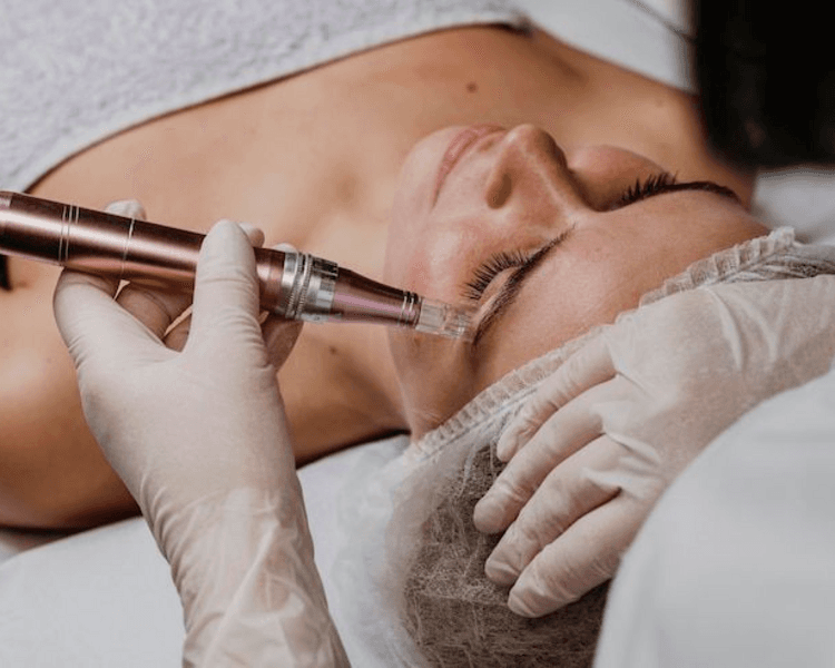 Limpieza facial con dermapen
