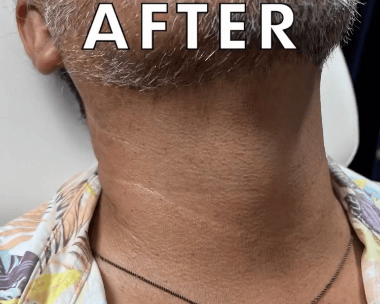 Retiro acrocordones con láser