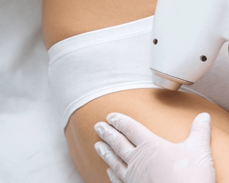 Sesión de depilación de bikini clásico (sesión)