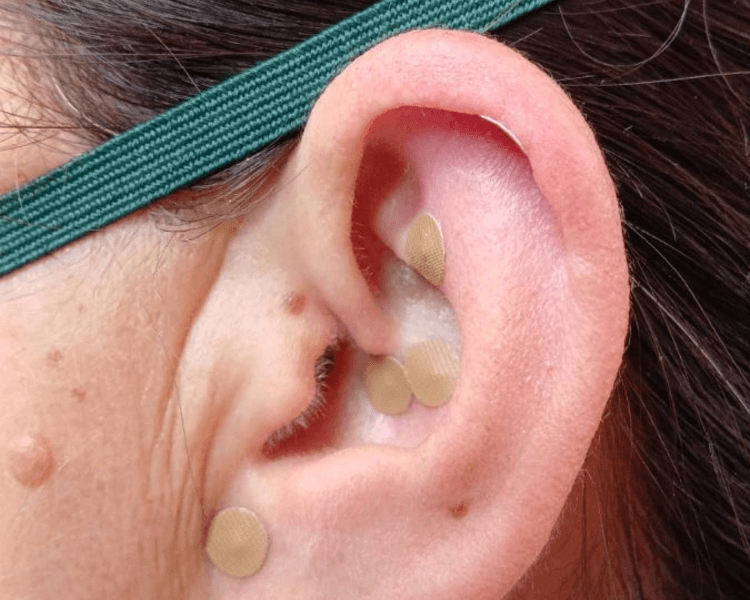 Ventosas y Auriculoterapia