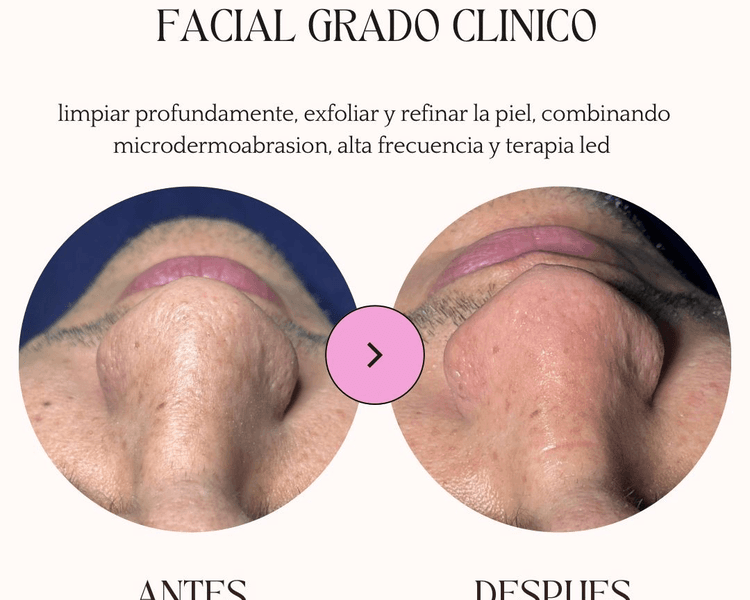 Facial Clínico Purificante ✨