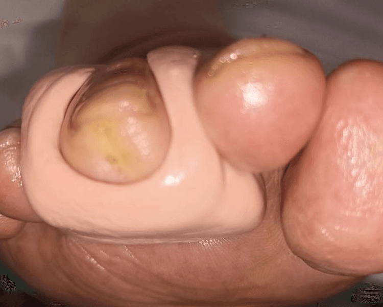 Tratamiento Ortesis de silicona