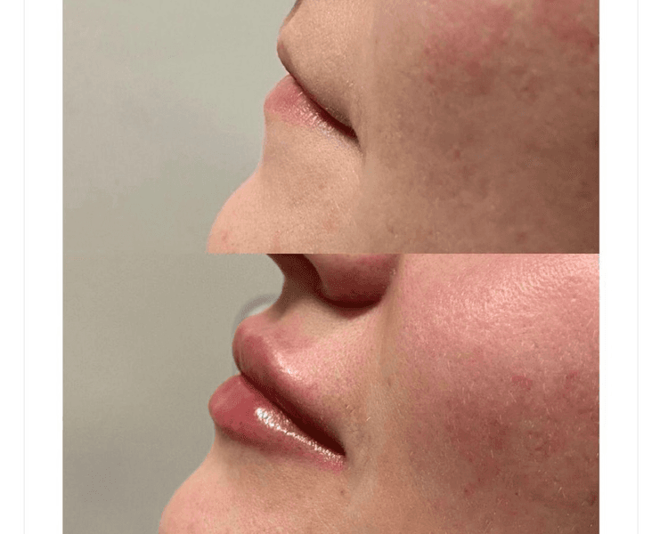 Aumento y diseño de labios