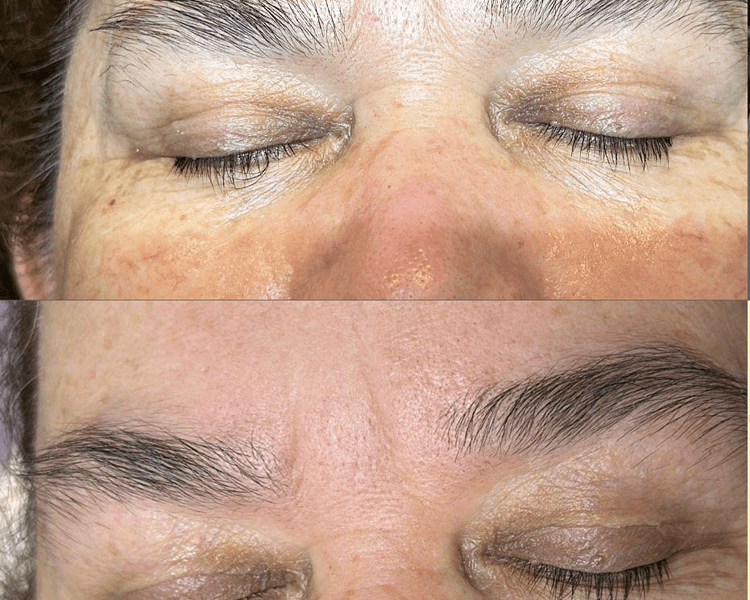 Blefaroplastia láser