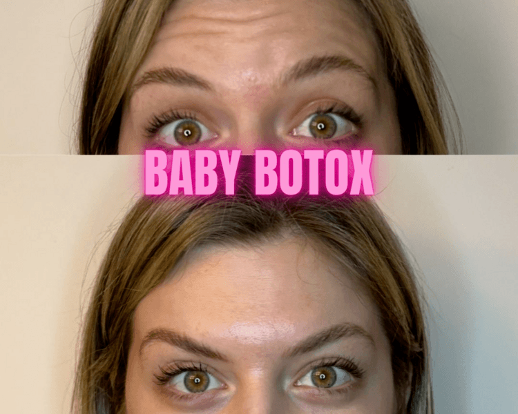 Toxina Botulinica (Botox)