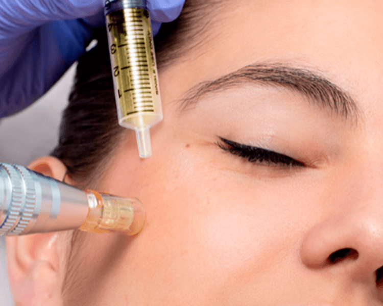 Plasma rico en plaquetas + exosomas