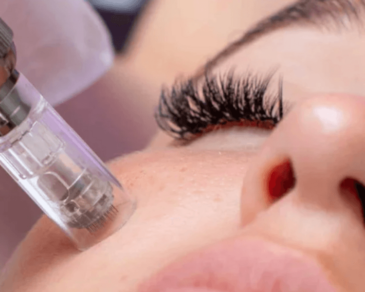 Limpieza facial profunda + dermapen con exosomas (microneedling)