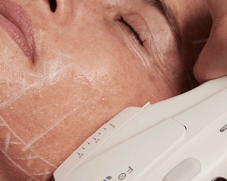 Liposonix/HIFU facial sábado 24 de octubre