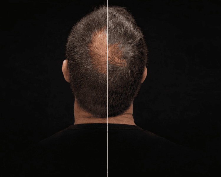 Tratamiento Anti-Caída del Cabello