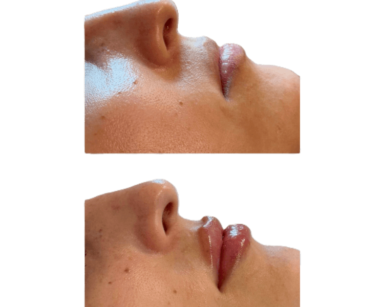 Ácido Hialurónico en Labios