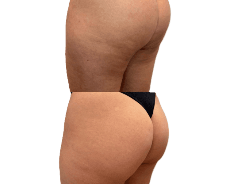 Mesoterapia MESOESTETIC