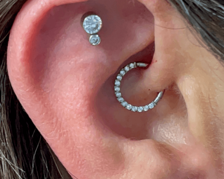 Perforación de Daith