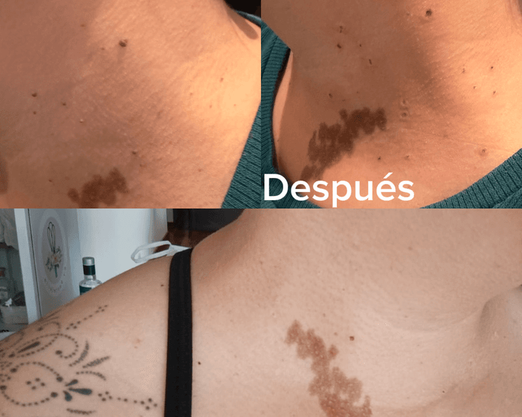 Extracción de lunares o acrocordones