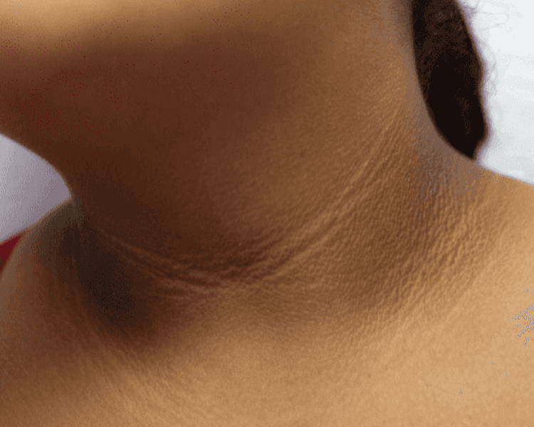 HIPERPIGMENTACIÓN cuello, pliegues, axilas...