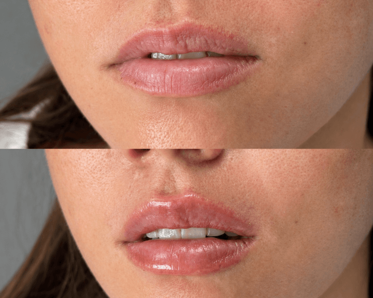 Diseño de Labios - Técnica exclusiva DRA. ANTO