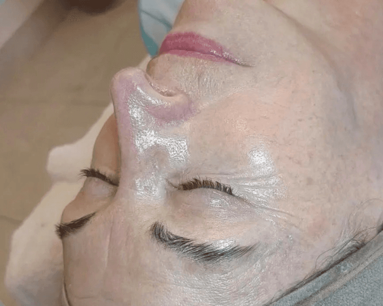 Facial Dermapen