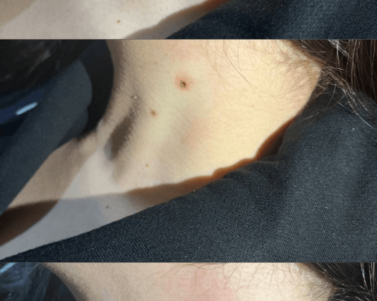 Plasmapen (eliminacion de lunares, acrocordones y verrugas)