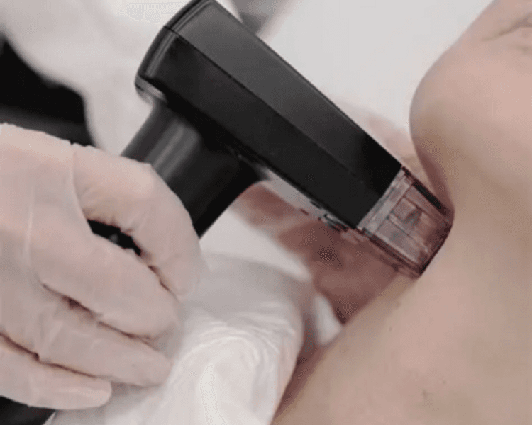 Radiofrecuencia Fraccionada + Exosomas (FACIAL) (6 sesiones)