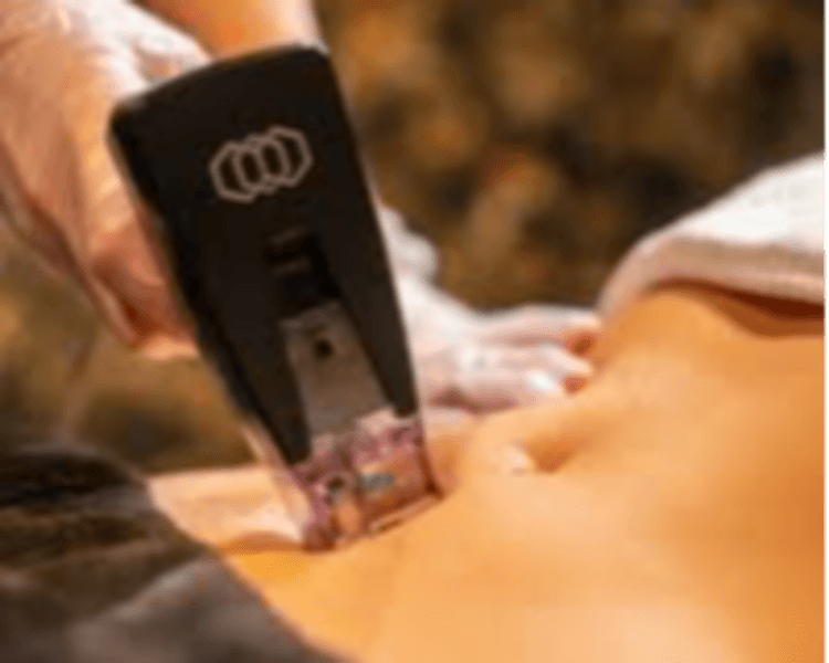 Protocolo Dual LIFTING 360 (HIFU + RF FRACCIONADA) (corporal)