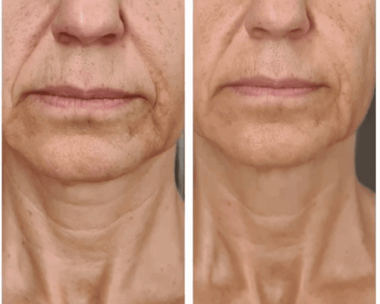 Drenaje Linfático Facial