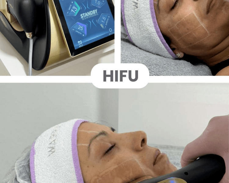 HIFU 22D rostro + cuello