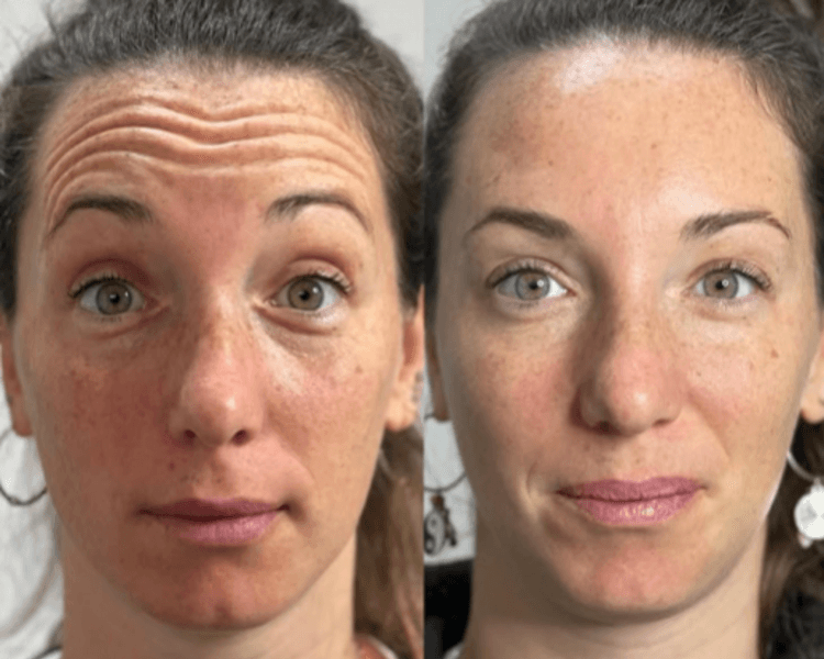 Evaluación para decidir tratamiento - armonización facial - otros