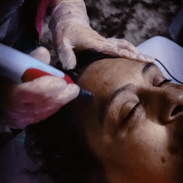 Limpieza facial + Induccion Ácido Hialurónico (Dermapen)