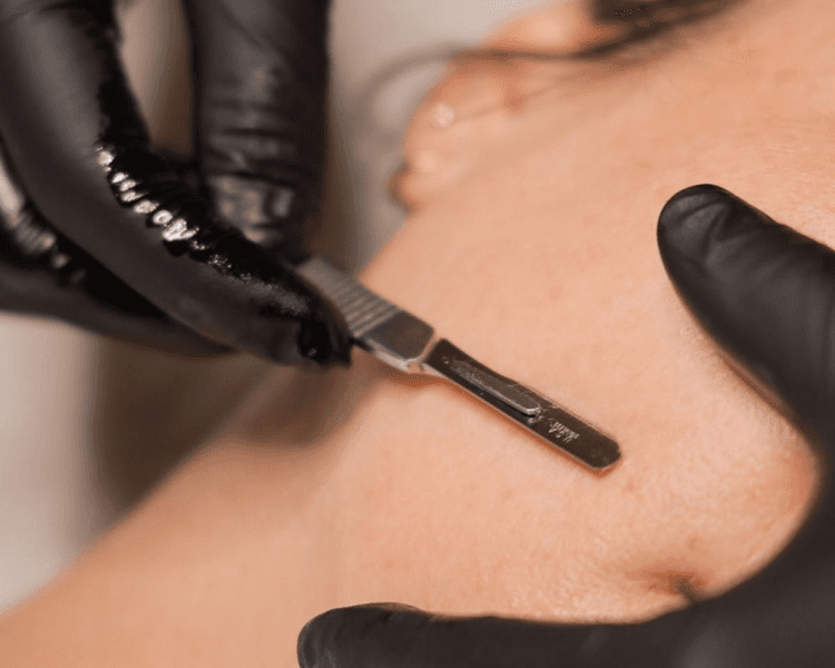 DERMAPLANING FACIAL