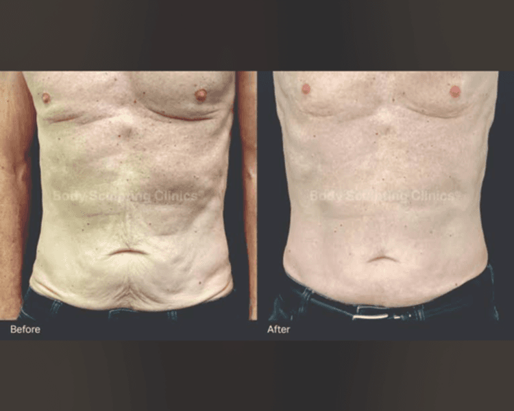 Himfu abdomen