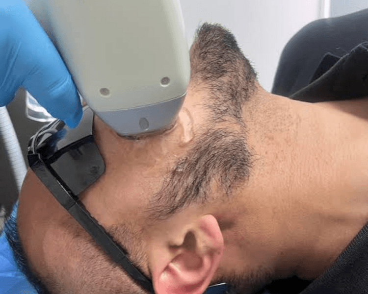 Perfilado de Barba 6 sesiones