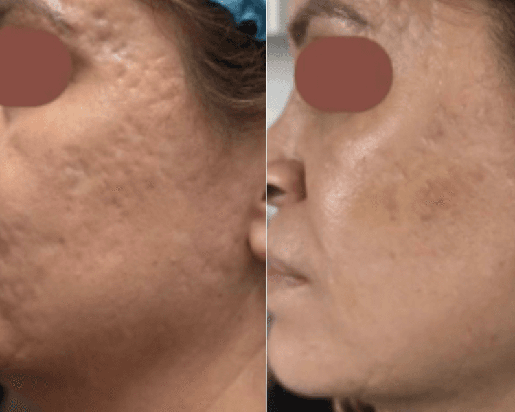 PDRN SALMÓN DERMAPEN