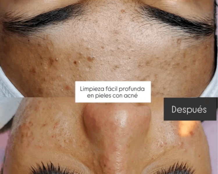 Limpieza Profunda Facial pieles c/ ACNE (c/ extracciones) TTO FACIAL MENSUAL