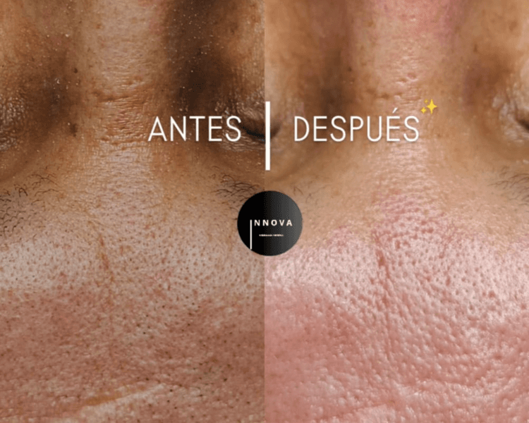 Limpieza Profunda Facial (c/ extracciones) TTO FACIAL MENSUAL