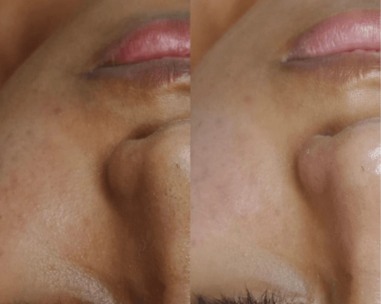 COMBO 5 - Dermaplaning facial + Limpieza profunda facial ( c/extracciones, exfoliación y depilación con Bisturí quirúrgico profesional)