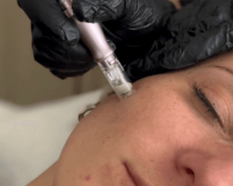 COMBO 2 - Facial limpieza profunda Super hidratante ( c/ extracciones) + Dermapen
