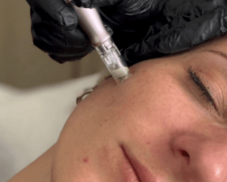 COMBO 4 - FACIAL "EXOSOMAS con PDRN SALMÓN y Dermapen (microneedling ) + Limpieza facial profunda (Con extracciones)