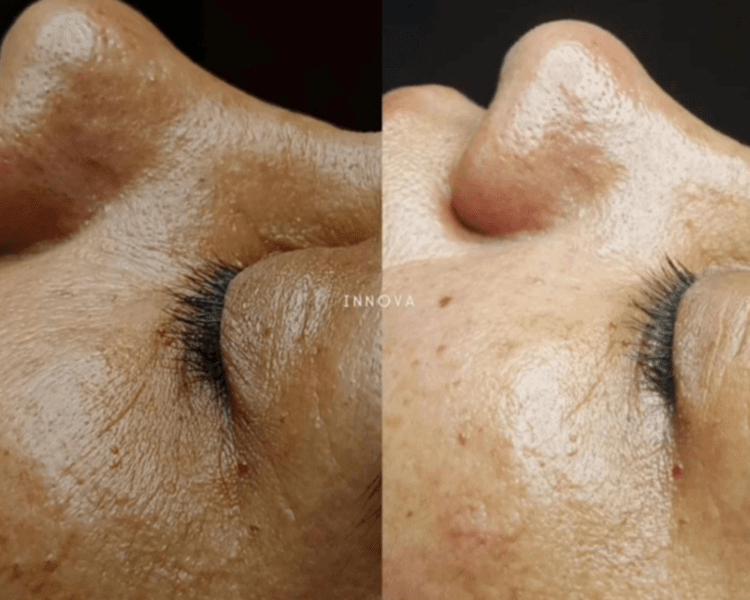 Limpieza Profunda facial + Peeling quimico o enzimatico facial ( antiage-renovadores-despigmentantes)