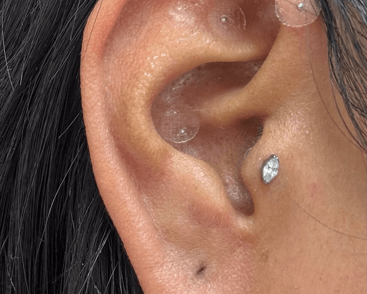 AURICULOTERAPIA