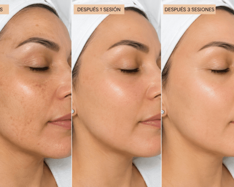 Peeling Quimico Casmara Three Action Peel