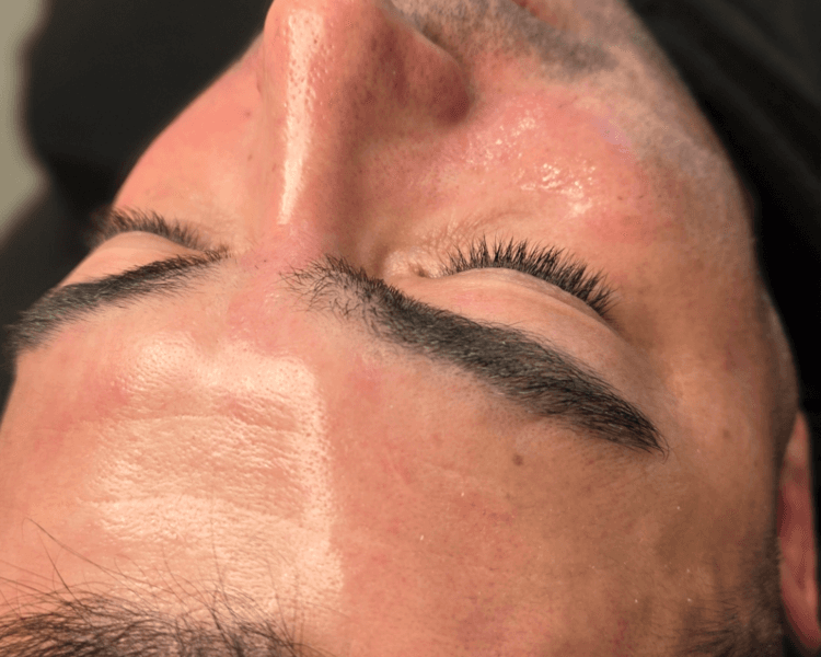Plasma Rico en Plaquetas facial