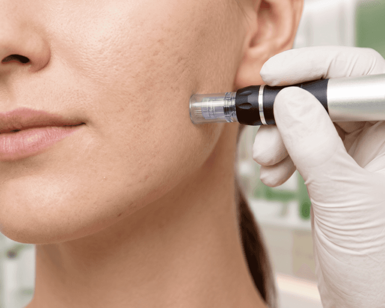 Sesión Dermapen para Cicatrices de Acné