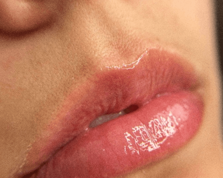 Hidratación de Labios con Ácido Hialuronico